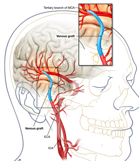 cerebrale bypassoperatie